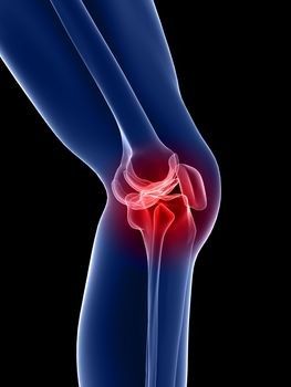 ACL Tear symptoms