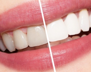 cosmetic dentistry and teeth whitening
