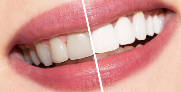 cosmetic dentistry and teeth whitening
