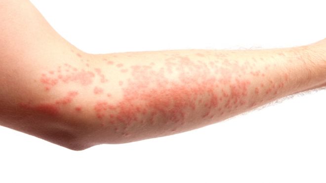 Eczema Conditions