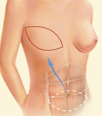 flap reconstruction breast surgery