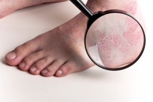 Psoriasis on a person's foot