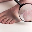 Understanding Psoriasis and Its Management in In-Home Care Settings