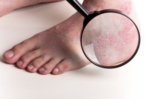 psoriasis and in-home care