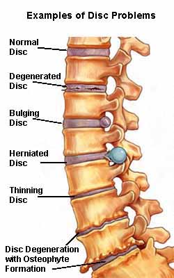 Herniated Disc