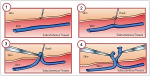 Phlebectomy