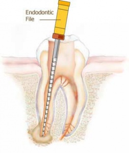 Root Canal