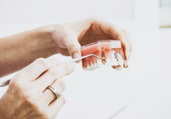 what are dental crowns