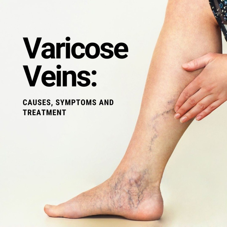 Varicose Veins & Recovery | Navigating Healthcare