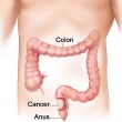 How to Lower the Risk of Colon Cancer