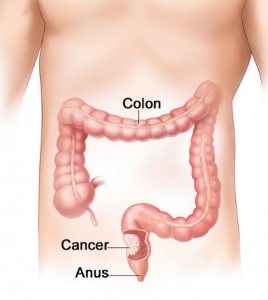 Colon Cancer