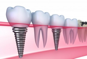 Dental Implants