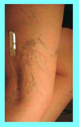 Spider Veins