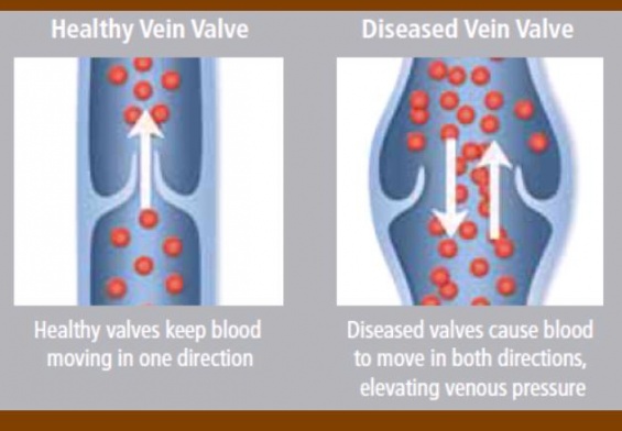 Venous Reflux Disease