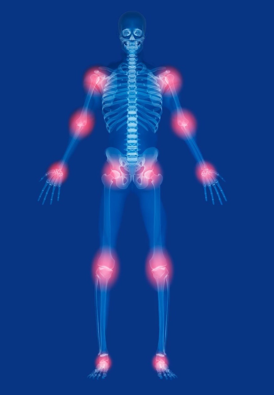 Arthritis joints