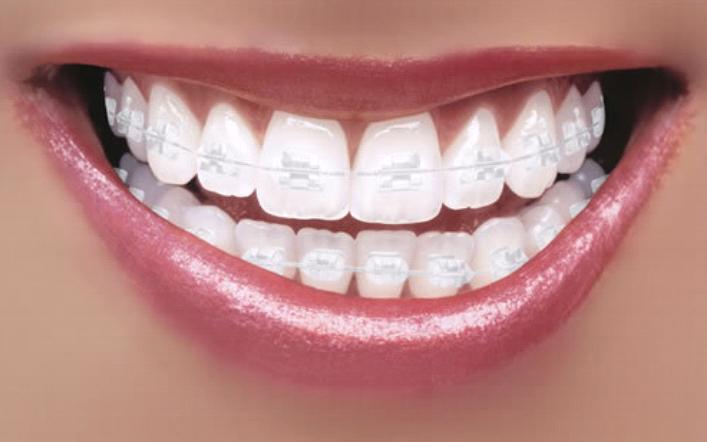 Benefits of Braces