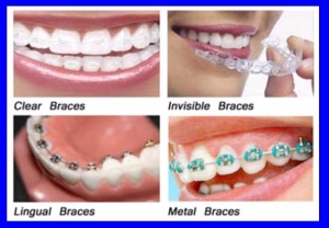 Types of braces