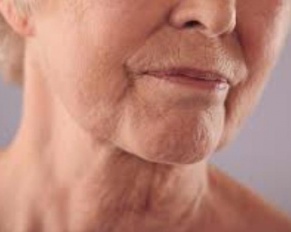 Dry Skin and Aging
