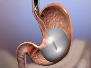 What Is an Intragastric Balloon