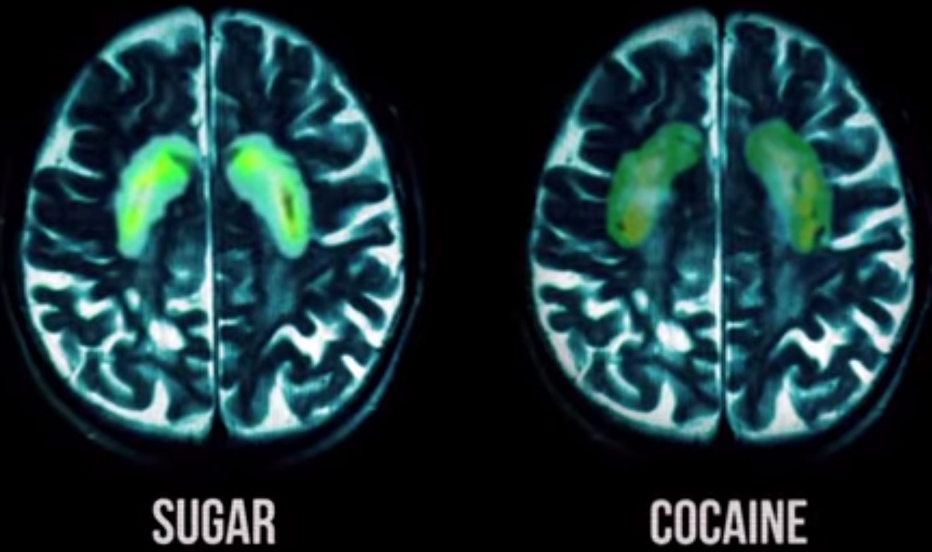 sugar’s effects on the brain