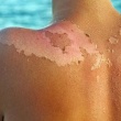 5 Things You Did Not Know About Sunburn
