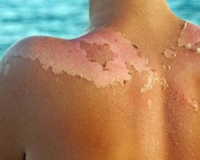 Things You Did Not Know About Sunburn