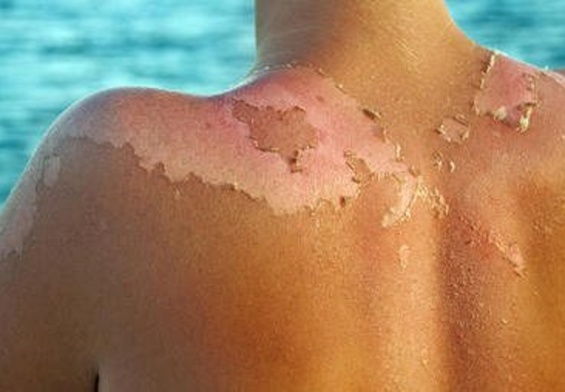 Things You Did Not Know About Sunburn