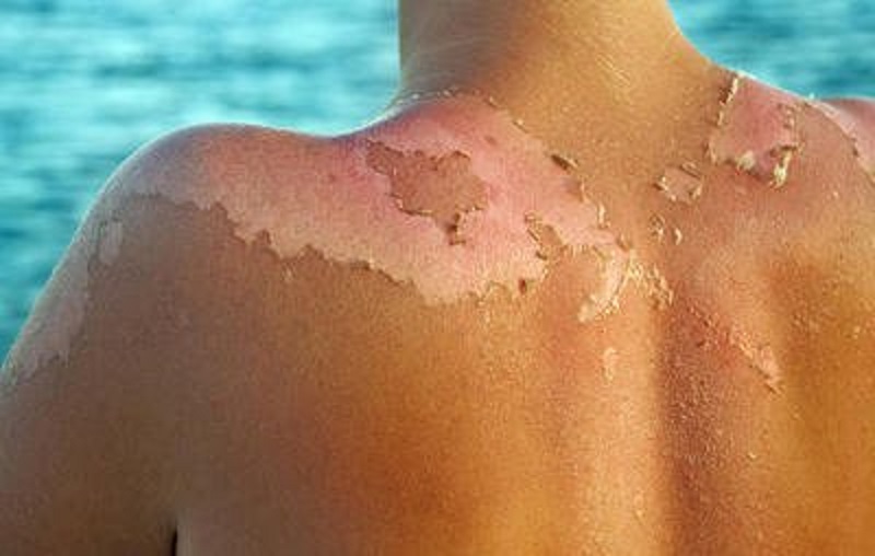 Things You Did Not Know About Sunburn sunburn in childhood
