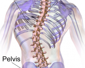 scoliosis spinal deformity