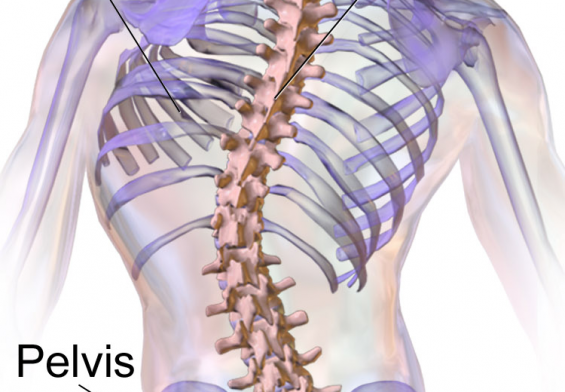scoliosis spinal deformity