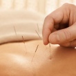 Acupuncture: What Is It and How Does It Work?