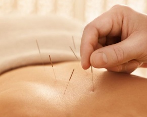 back acupuncture