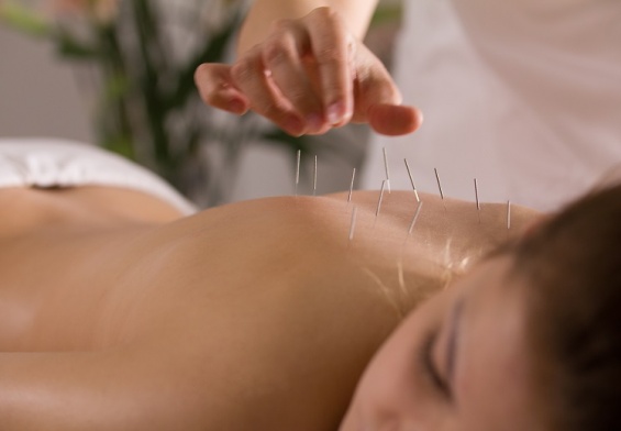 acupuncture needles in girl's back