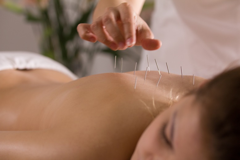 acupuncture needles in girl's back