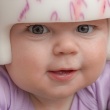 Deformational Plagiocephaly: Unpacking the Latest Research on Diagnosis and Treatment