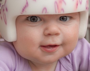 baby in cranial orthosis