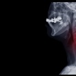 Cervical Spinal Fusion- What is it and What Should I Expect?
