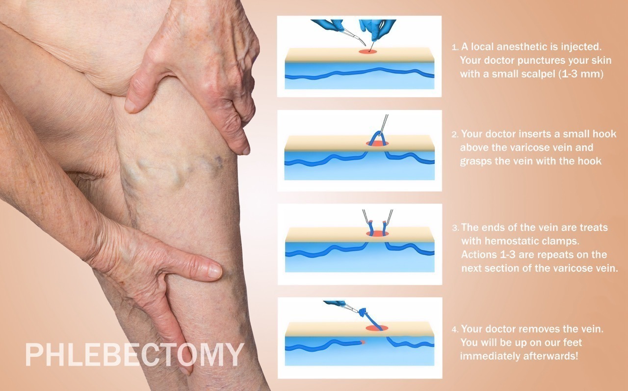 Phlebectomy Treatment for varicose vein.