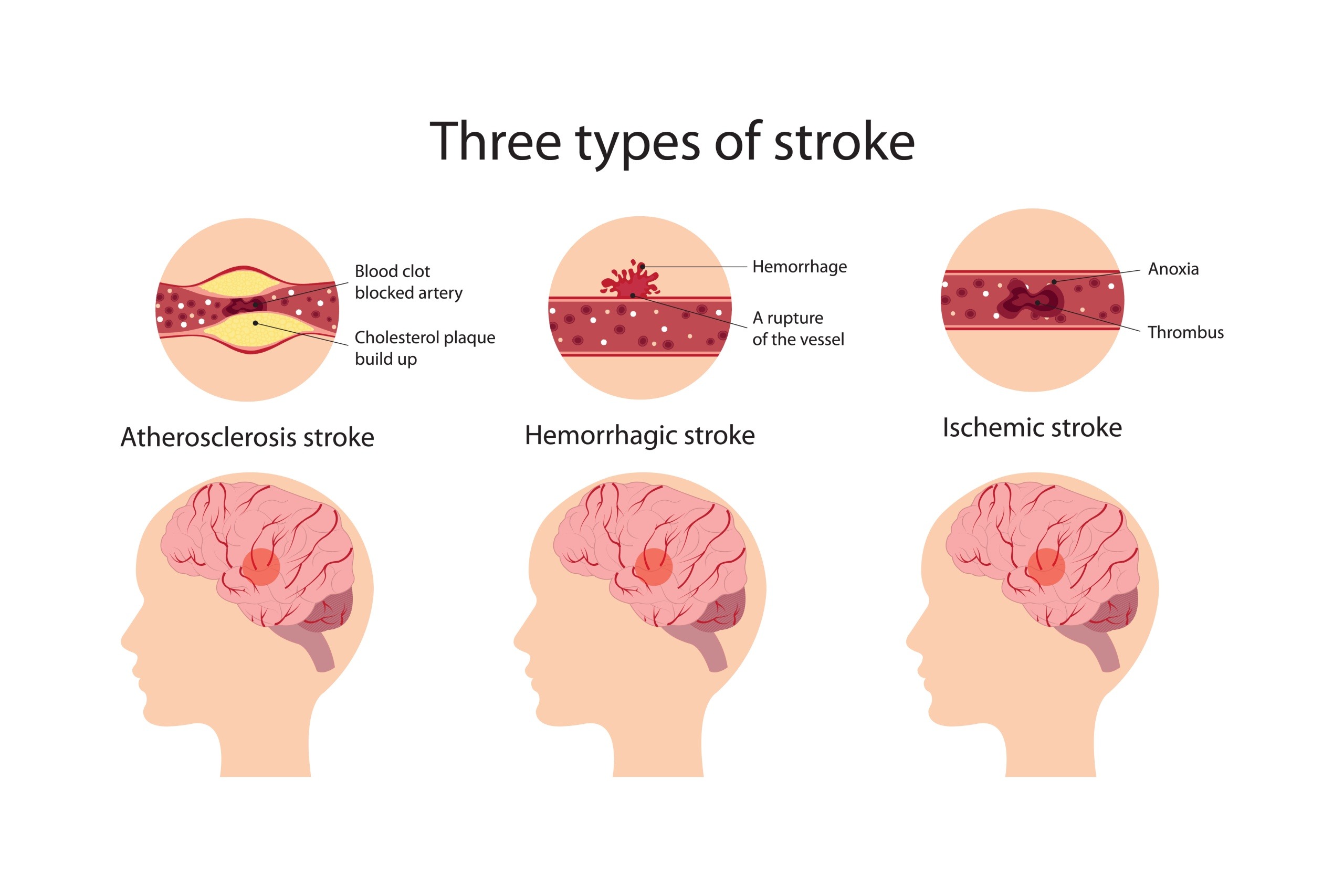 types of stroke