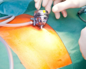 afraid of back surgery