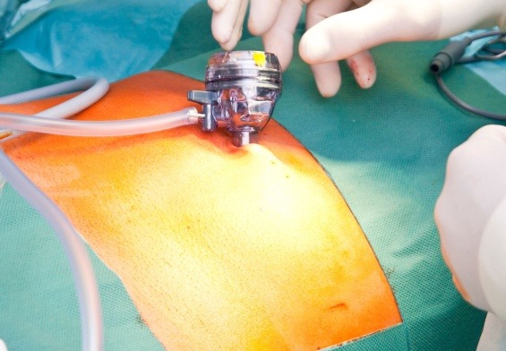 afraid of back surgery