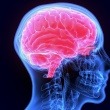 Glioma Symptoms: What Sets This Brain Tumor Apart From Others