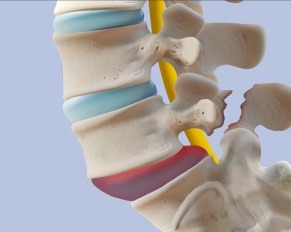 Spondylolysis
