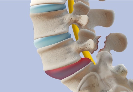 Spondylolysis