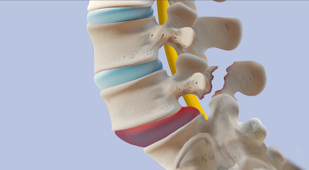 Spondylolysis