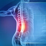 Spinal Cord Stimulator: Who Qualifies and What the Trial Period Involves
