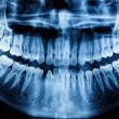 What Does Cancer Look Like on a Dental X-Ray?