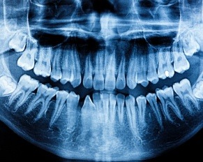 what does cancer look like on a dental x-ray