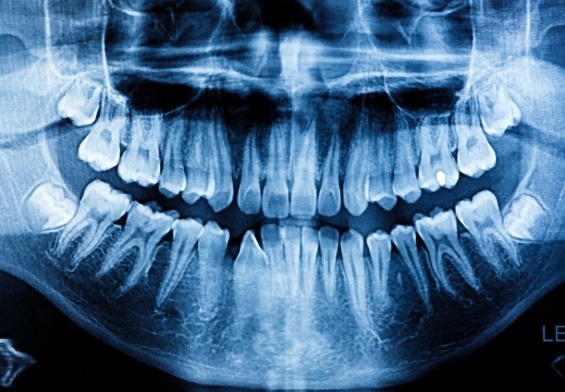 what does cancer look like on a dental x-ray