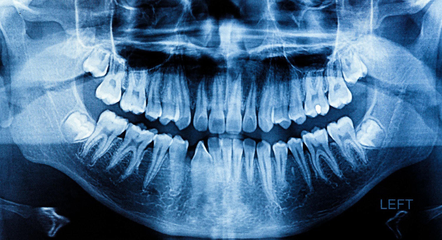 what does cancer look like on a dental x-ray